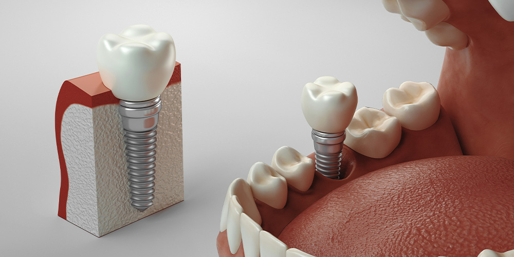 Permanent tooth replacement using artificial dental roots