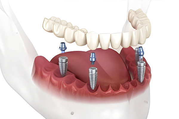 all-on-4-dental-implants-dubai all-on-4-dental-implants-dubai