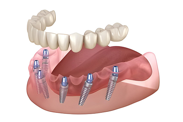 all-on-6-dental-implants-dubai all-on-6-dental-implants-dubai
