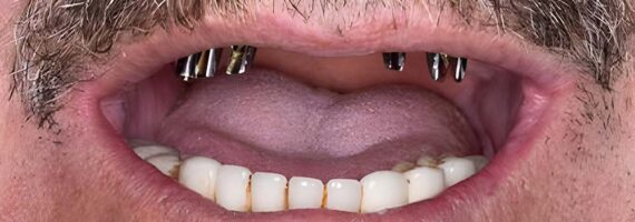 dental-implant-before-and-after-case-2