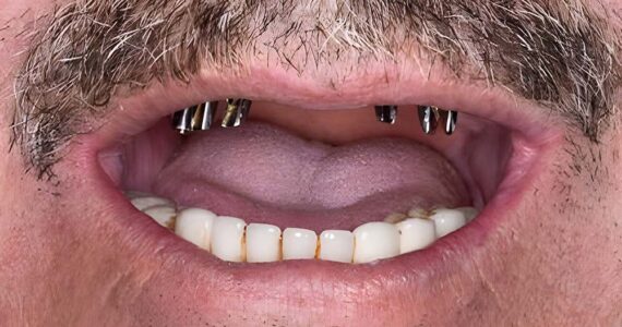 dental-implant-before-and-after-case-2