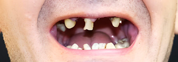 dental-implant-before-and-after-case