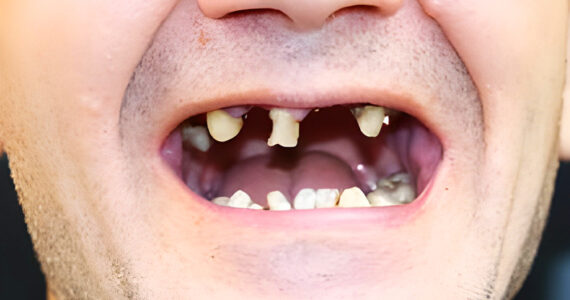 dental-implant-before-and-after-case
