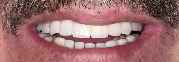 dental-implants-before-and-after-case-2