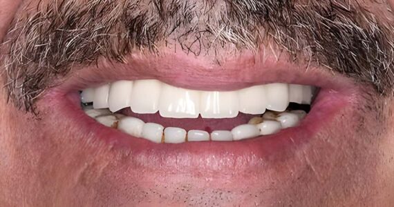 dental-implants-before-and-after-case-2