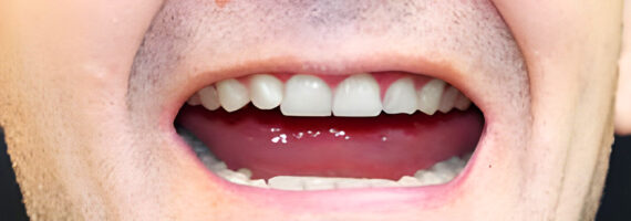 dental-implants-before-and-after-case