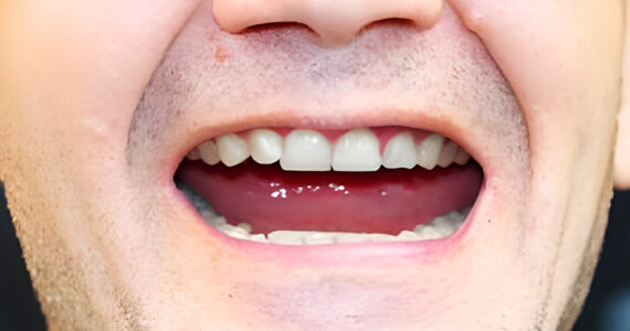 dental-implants-before-and-after-case