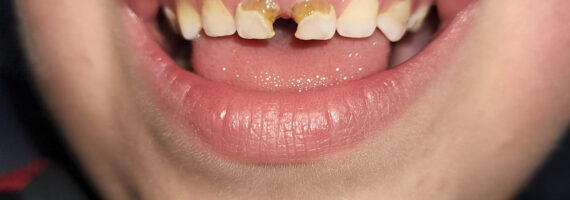 pediatric-dental-before-and-after-case-1