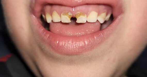 pediatric-dental-before-and-after-case-1