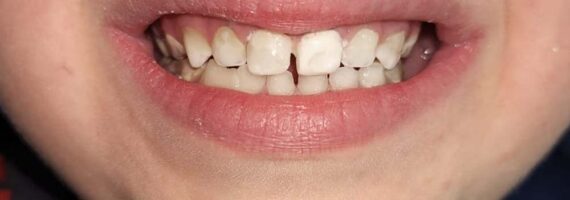 pediatric-dental-before-and-after-case-2