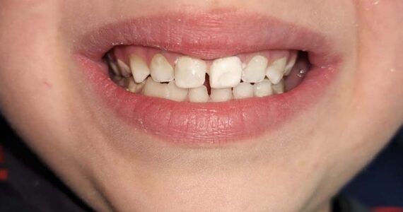pediatric-dental-before-and-after-case-2