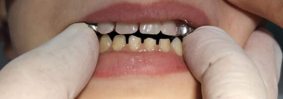 pediatric-dental-before-and-after-case-3