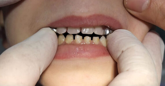 pediatric-dental-before-and-after-case-3