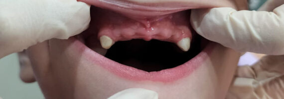 pediatric-dental-before-and-after-case-4
