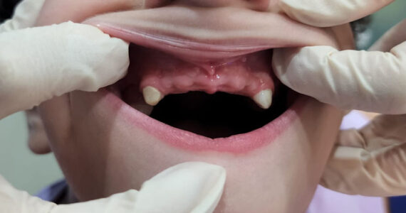 pediatric-dental-before-and-after-case-4