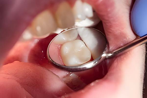 tooth-filling-for-childrens tooth-filling-for-childrens