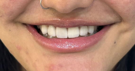 After - dental veneer