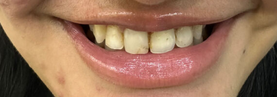 Before - dental veneer