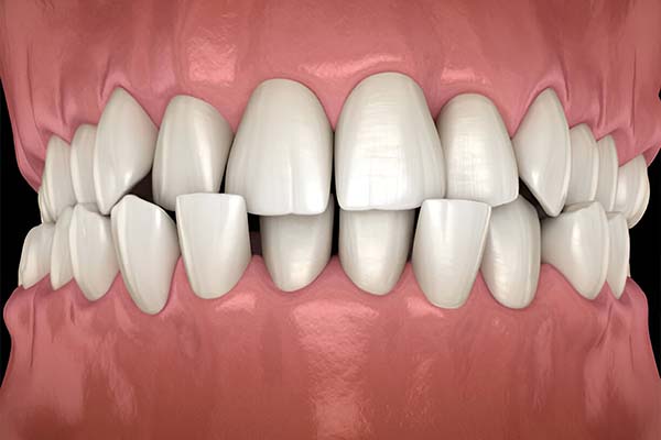 Cross Bite Perfecting Smiles with Advanced Ortho Solutions
