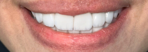 dental veneer - after