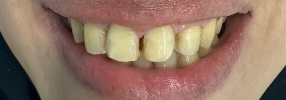 dental veneer - before
