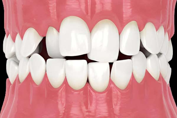 Overcrowded Elevating Smiles with Modern Ortho Excellence