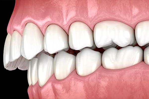 Permanent tooth replacement using artificial dental roots