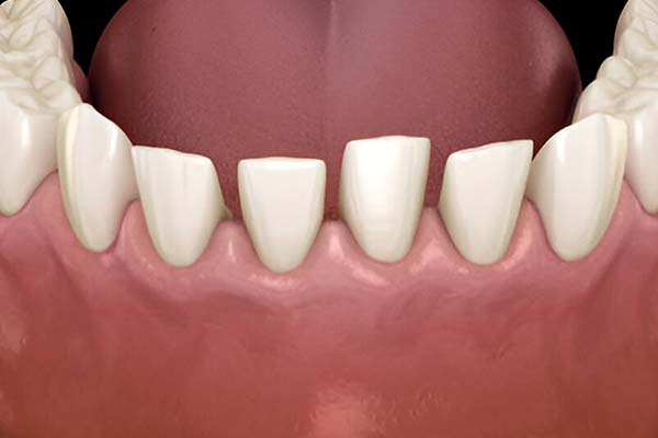 Permanent tooth replacement using artificial dental roots