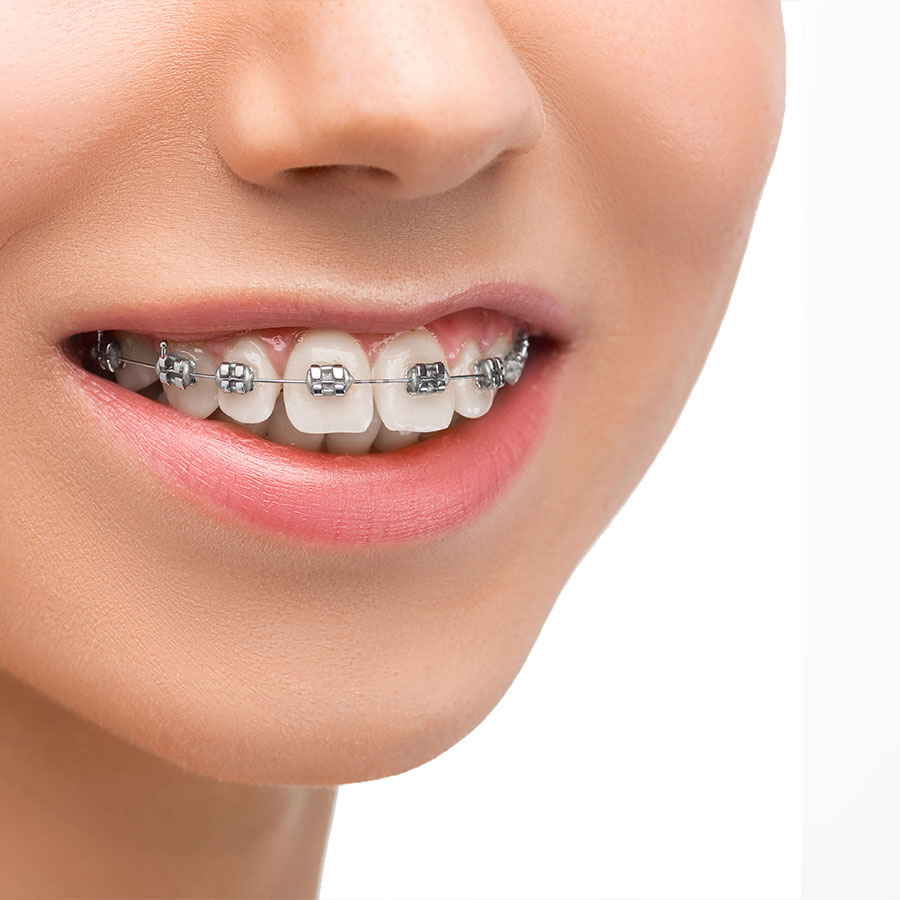 teeth-straightening-dubai teeth-straightening-dubai