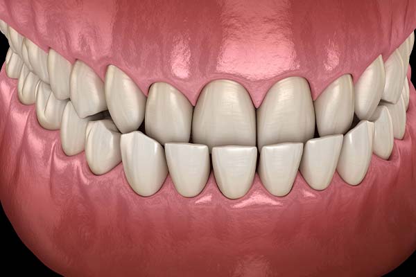 Permanent tooth replacement using artificial dental roots