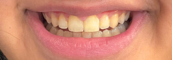 before-teeth-cleaning