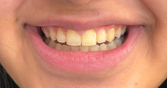 before-teeth-cleaning