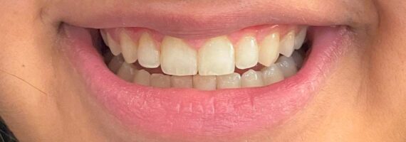 teeth-cleaning-before