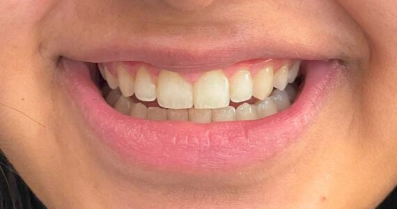 teeth-cleaning-before
