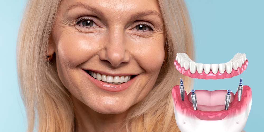 Full arch restoration with fewer implants.