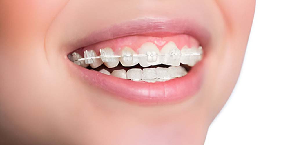 Aesthetic braces for less visible correction.