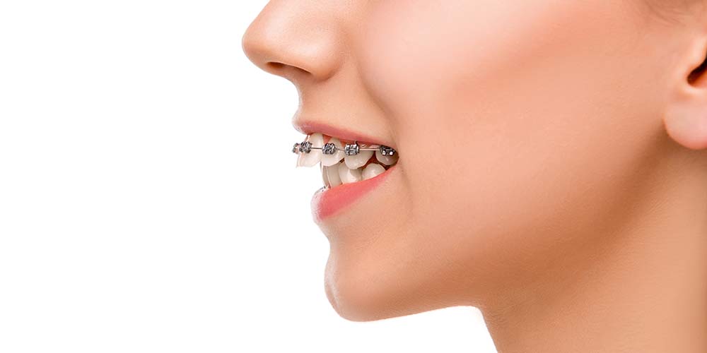 Advanced braces for faster, gentler alignment.