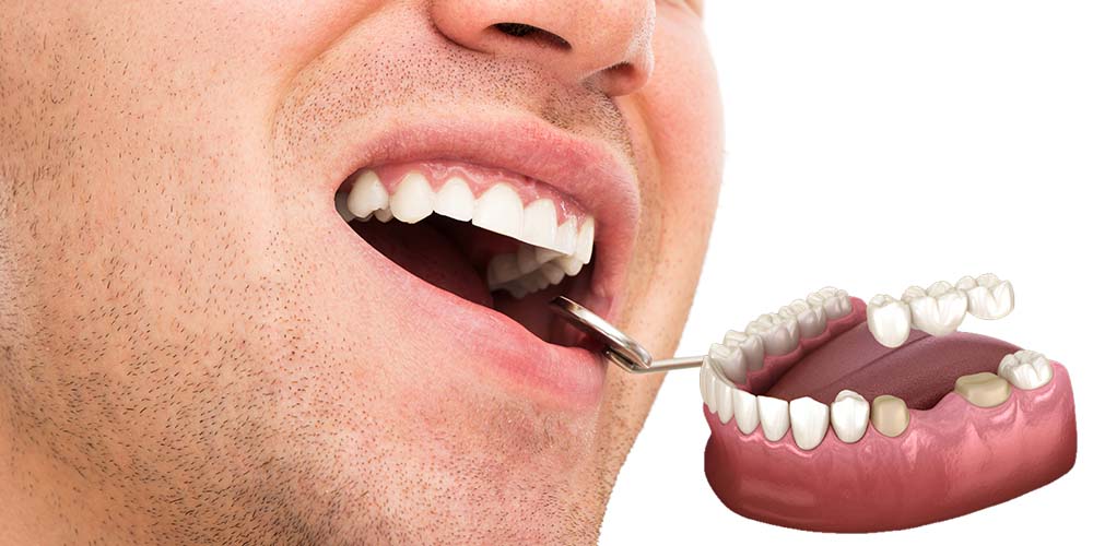 Replace missing teeth with seamless bridges.
