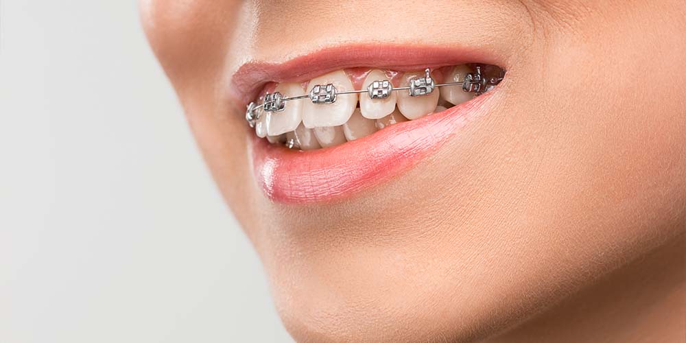 Classic braces for effective teeth alignment.