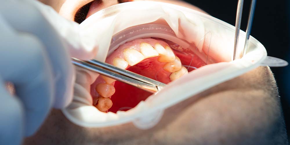 Expert surgical solutions for oral concerns in Dubai.