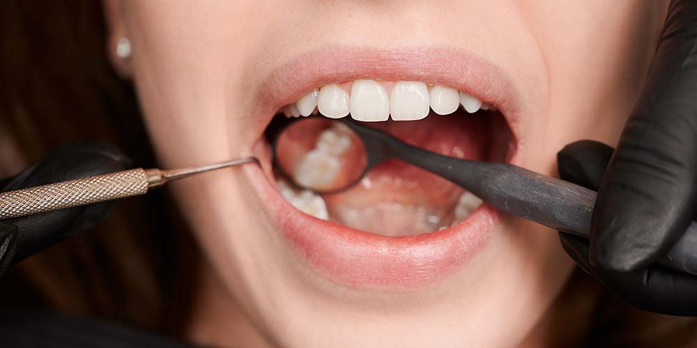 Restore cavities with durable fillings.