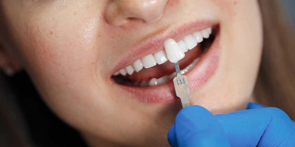 Transform smiles with porcelain veneers.