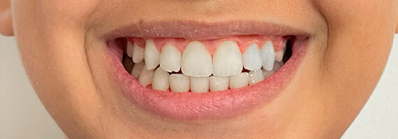 braces-after 2