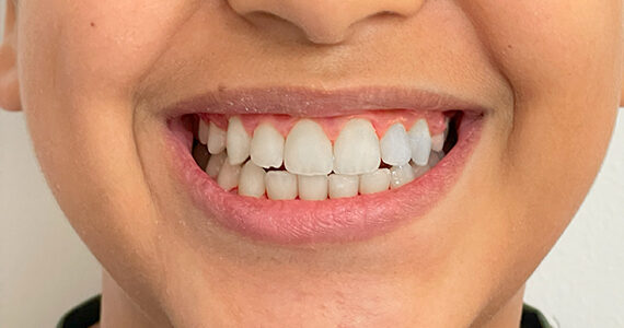 braces-after 2