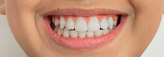 braces-after 3