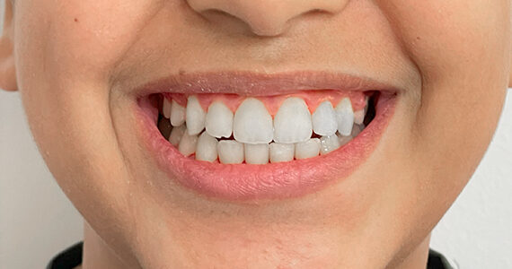 braces-after 3