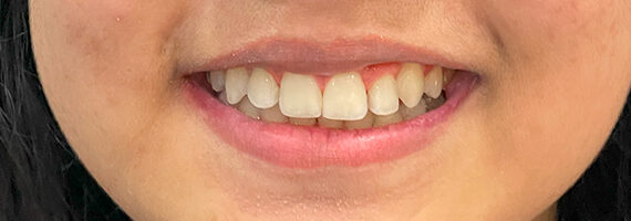 braces-after