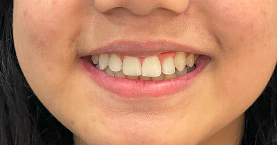 braces-after