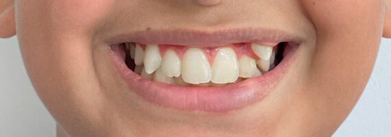 braces-before 1