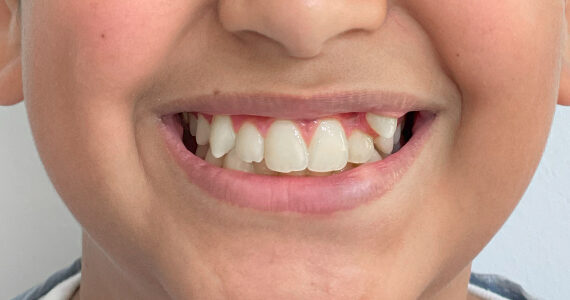 braces-before 1
